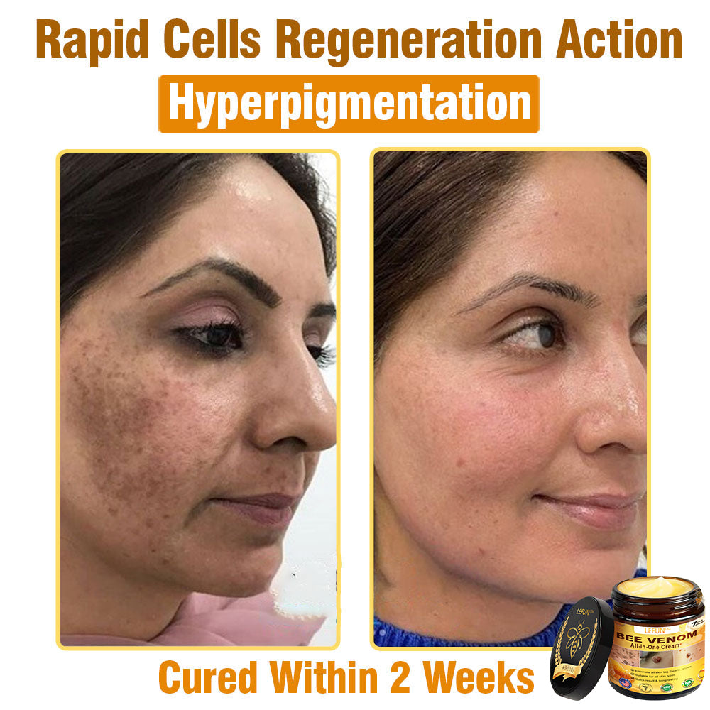 LEFUN™ Bee Venom All-in-One Cream US Dermatologist Approved-🔥🔥