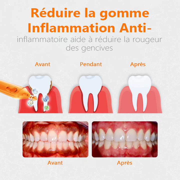 👑👑Flacons de traitement Cvreoz® pour la réparation des gencives