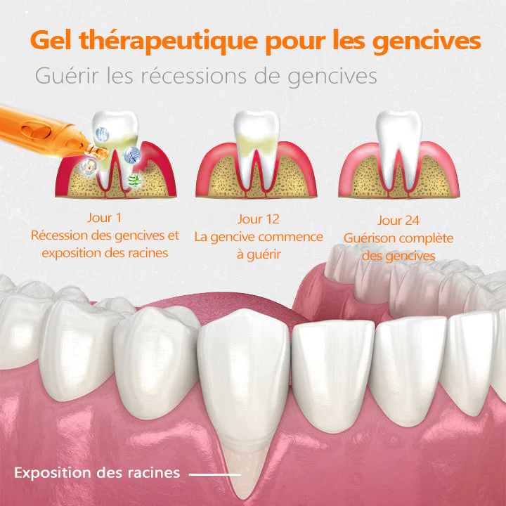 👑👑Flacons de traitement Cvreoz® pour la réparation des gencives