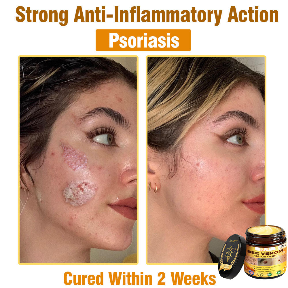 LEFUN™ Bee Venom All-in-One Cream US Dermatologist Approved-🔥🔥