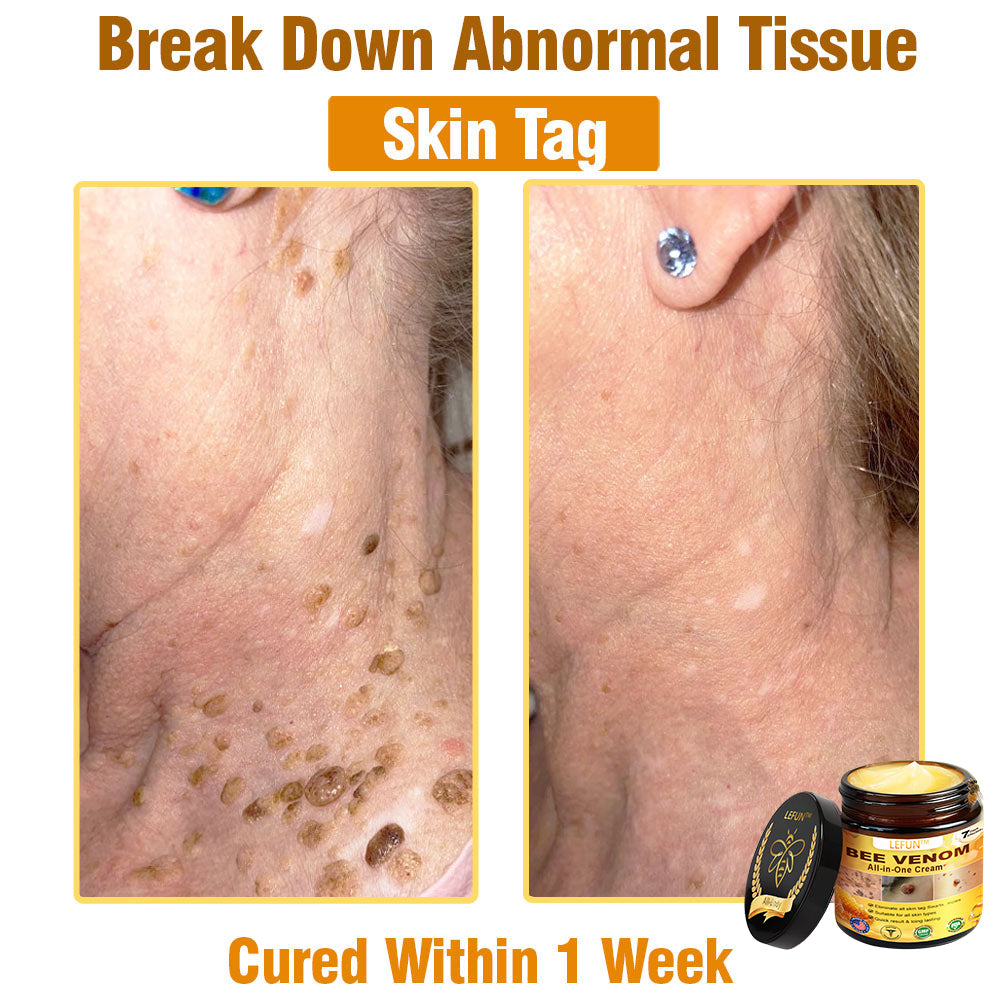 LEFUN™ Bee Venom All-in-One Cream US Dermatologist Approved-🔥🔥