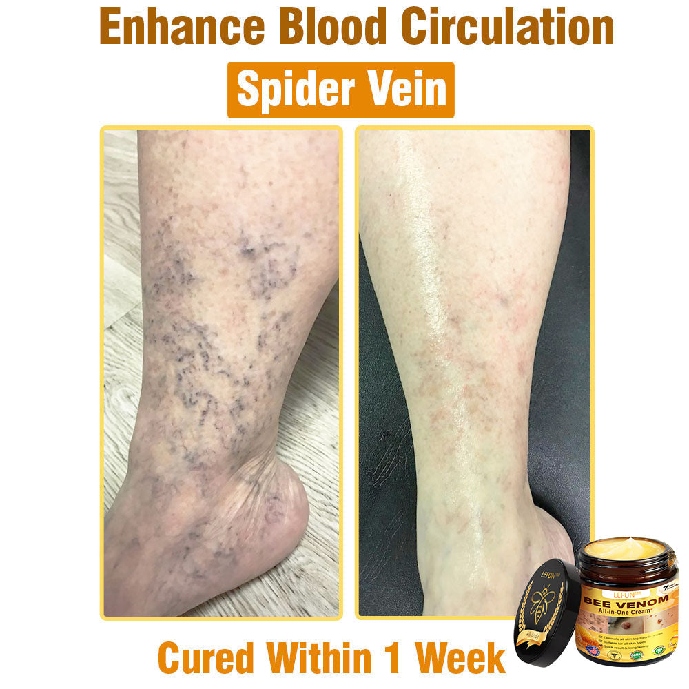 LEFUN™ Bee Venom All-in-One Cream US Dermatologist Approved-🔥🔥