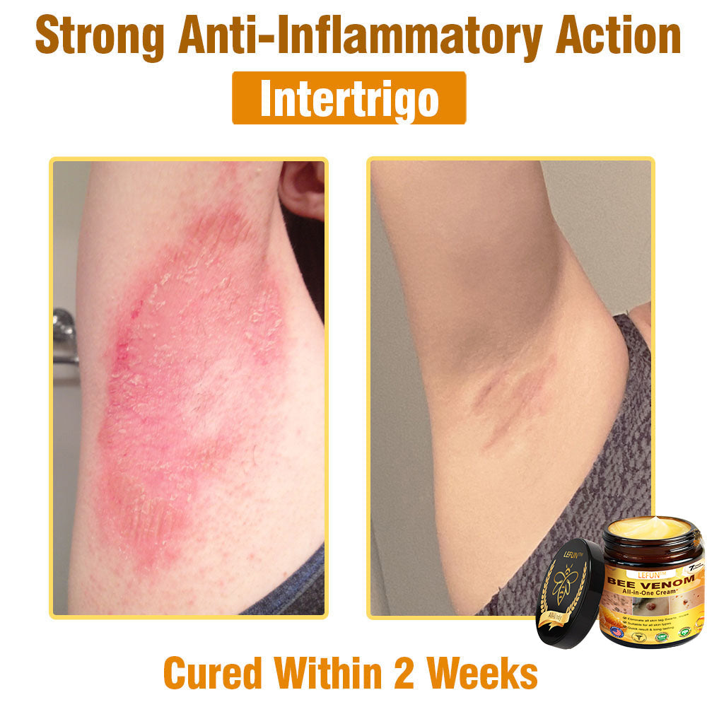 LEFUN™ Bee Venom All-in-One Cream US Dermatologist Approved-🔥🔥