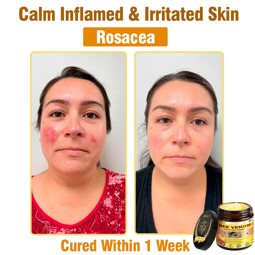 LEFUN™ Bee Venom All-in-One Cream US Dermatologist Approved-🔥🔥