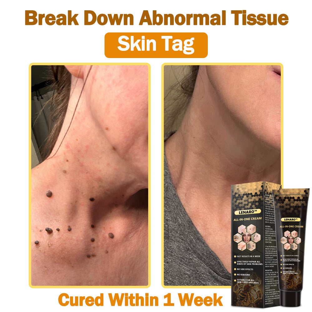 【LAST DAY 70% OFF】 💎 𝐋𝐞𝐧𝐚𝐫𝐨™ All-in-one Cream (👩⚕️CDA Recommends,Repair all kinds of skin problems)