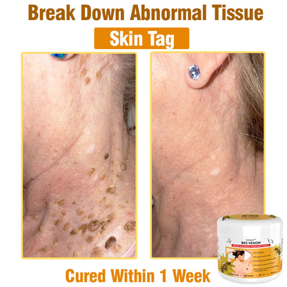 𝙇𝙚𝙣𝙖𝙧𝙤™ 𝘽𝙚𝙚 𝙑𝙚𝙣𝙤𝙢 𝙎𝙠𝙞𝙣 𝙏𝙧𝙚𝙖𝙩𝙢𝙚𝙣𝙩 𝘾𝙧𝙚𝙖𝙢👨‍⚕️ (Suitable for all ages & TPD recommends)🌟