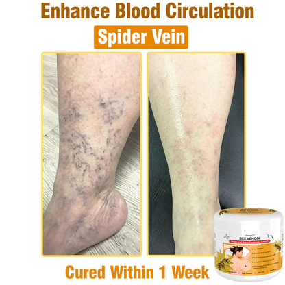 𝙇𝙚𝙣𝙖𝙧𝙤™ 𝘽𝙚𝙚 𝙑𝙚𝙣𝙤𝙢 𝙎𝙠𝙞𝙣 𝙏𝙧𝙚𝙖𝙩𝙢𝙚𝙣𝙩 𝘾𝙧𝙚𝙖𝙢👨‍⚕️ (Suitable for all ages & TPD recommends)🌟