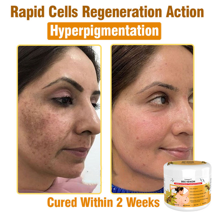 𝙇𝙚𝙣𝙖𝙧𝙤™ 𝘽𝙚𝙚 𝙑𝙚𝙣𝙤𝙢 𝙎𝙠𝙞𝙣 𝙏𝙧𝙚𝙖𝙩𝙢𝙚𝙣𝙩 𝘾𝙧𝙚𝙖𝙢👨‍⚕️ (Suitable for all ages & TPD recommends)🌟