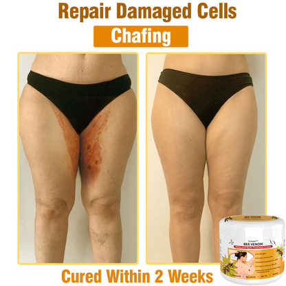 𝙇𝙚𝙣𝙖𝙧𝙤™ 𝘽𝙚𝙚 𝙑𝙚𝙣𝙤𝙢 𝙎𝙠𝙞𝙣 𝙏𝙧𝙚𝙖𝙩𝙢𝙚𝙣𝙩 𝘾𝙧𝙚𝙖𝙢👨‍⚕️ (Suitable for all ages & TPD recommends)🌟