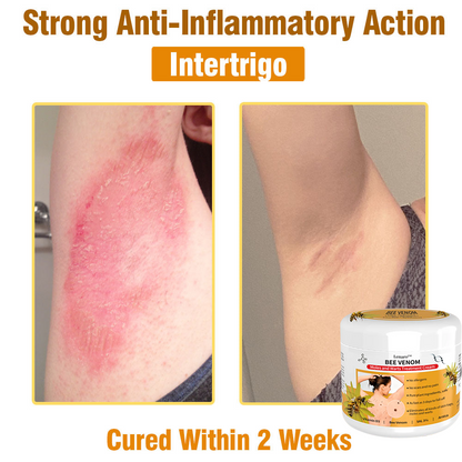 𝙇𝙚𝙣𝙖𝙧𝙤™ 𝘽𝙚𝙚 𝙑𝙚𝙣𝙤𝙢 𝙎𝙠𝙞𝙣 𝙏𝙧𝙚𝙖𝙩𝙢𝙚𝙣𝙩 𝘾𝙧𝙚𝙖𝙢👨‍⚕️ (Suitable for all ages & TPD recommends)🌟