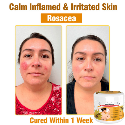 𝙇𝙚𝙣𝙖𝙧𝙤™ 𝘽𝙚𝙚 𝙑𝙚𝙣𝙤𝙢 𝙎𝙠𝙞𝙣 𝙏𝙧𝙚𝙖𝙩𝙢𝙚𝙣𝙩 𝘾𝙧𝙚𝙖𝙢👨‍⚕️ (Suitable for all ages & TPD recommends)🌟