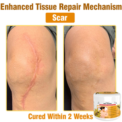 𝙇𝙚𝙣𝙖𝙧𝙤™ 𝘽𝙚𝙚 𝙑𝙚𝙣𝙤𝙢 𝙎𝙠𝙞𝙣 𝙏𝙧𝙚𝙖𝙩𝙢𝙚𝙣𝙩 𝘾𝙧𝙚𝙖𝙢👨‍⚕️ (Suitable for all ages & TPD recommends)🌟