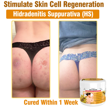 𝙇𝙚𝙣𝙖𝙧𝙤™ 𝘽𝙚𝙚 𝙑𝙚𝙣𝙤𝙢 𝙎𝙠𝙞𝙣 𝙏𝙧𝙚𝙖𝙩𝙢𝙚𝙣𝙩 𝘾𝙧𝙚𝙖𝙢👨‍⚕️ (Suitable for all ages & TPD recommends)🌟