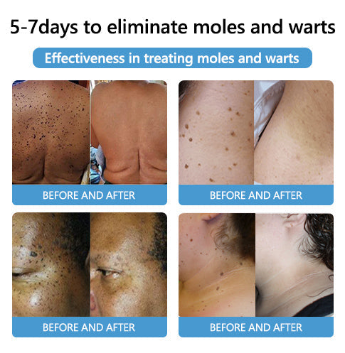 [🍀🍀Official Brand Shop🐝] LEFUN™Bee Venom Mole and Wart Treatment Cream(👨‍⚕AAD RECOMMENDS)x