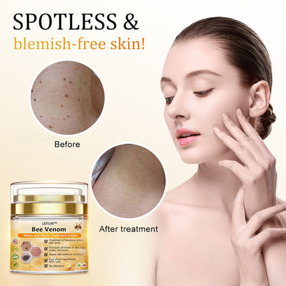 [🍀🍀Official Brand Shop🐝] LEFUN™Bee Venom Mole and Wart Treatment Cream(👨‍⚕AAD RECOMMENDS)x