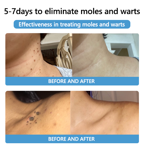 [🍀🍀Official Brand Shop🐝] LEFUN™Bee Venom Mole and Wart Treatment Cream(👨‍⚕AAD RECOMMENDS)x