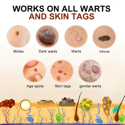 [🍀🍀Official Brand Shop🐝] LEFUN™Bee Venom Mole and Wart Treatment Cream(👨‍⚕AAD RECOMMENDS)x