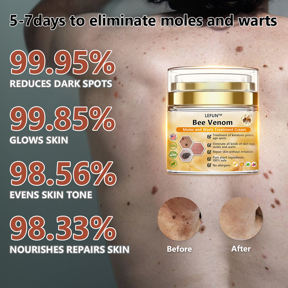 [🍀🍀Official Brand Shop🐝] LEFUN™Bee Venom Mole and Wart Treatment Cream(👨‍⚕AAD RECOMMENDS)x